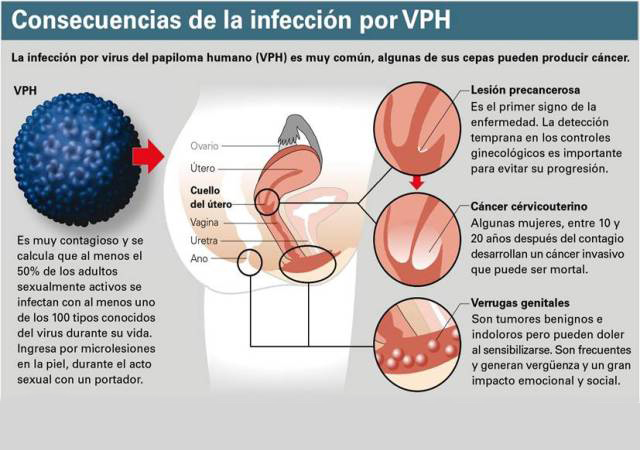 >virus del Papiloma humano